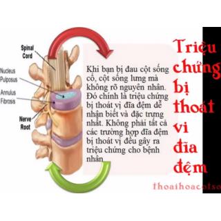 Cách tập xà đơn chữa thoát vị đãi đệm