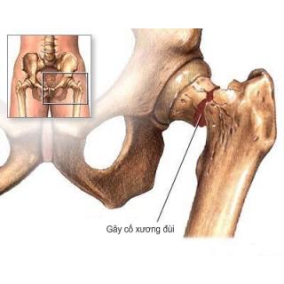 Làm thế nào để chữa trị cho người bị gãy xương đùi