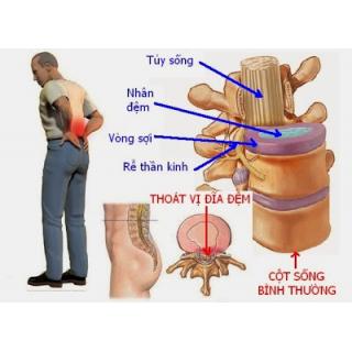 Xe đạp tập thể dục giúp chữa thoát vị đĩa đệm