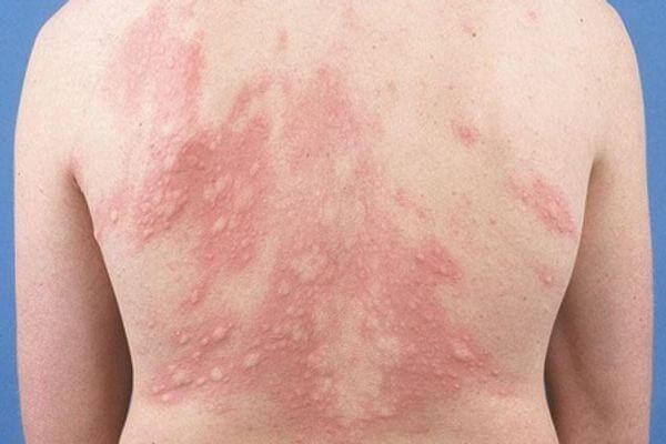 Tac-dung-tri-lieu-cua-cay-com-nguoi-5